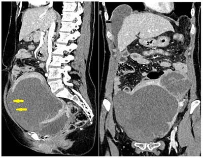 Case report: Spontaneous rupture of leiomyosarcoma uteri 8 months after primary laparoscopic surgery of STUMP